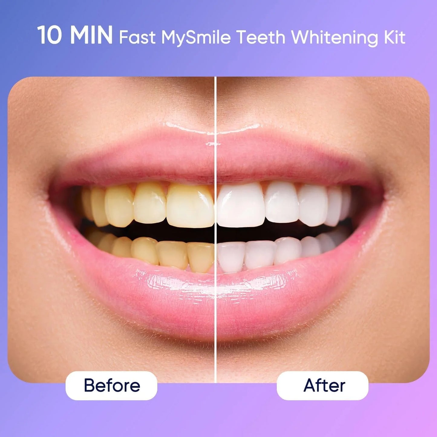 Kit De Blanqueamiento Dental Definitivo Con 28 Luces LED, 10 Min 4X 3ML 35% CP Gel Blanqueador De Dientes, 1X 4ML Bolígrafo Blanqueador De Dientes Elimina 10 Años De Manchas