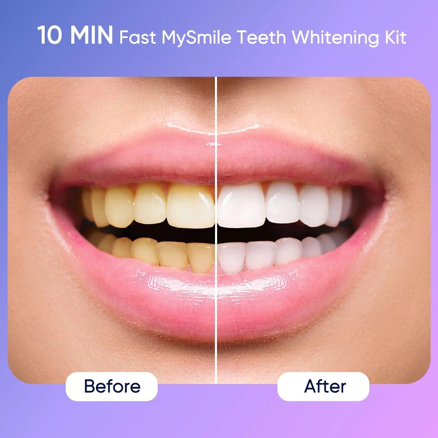 Kit De Blanqueamiento Dental Definitivo Con 28 Luces LED, 10 Min 4X 3ML 35% CP Gel Blanqueador De Dientes, 1X 4ML Bolígrafo Blanqueador De Dientes Elimina 10 Años De Manchas